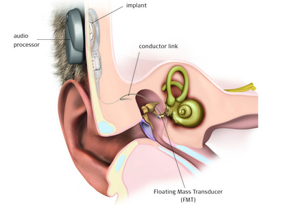 middle ear implant cost